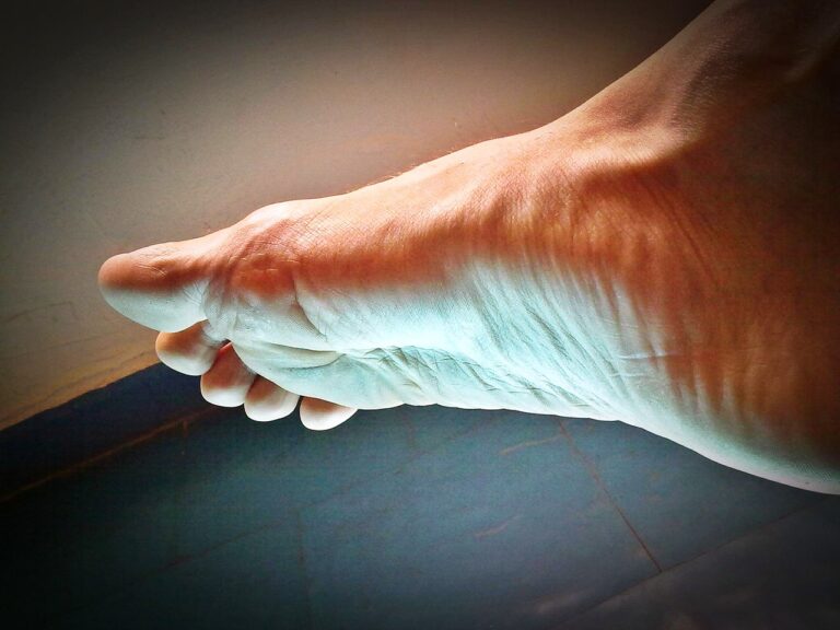 Choroba, która zabiera nogi